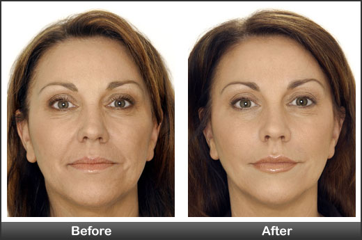 Botox & Fillers before-after
